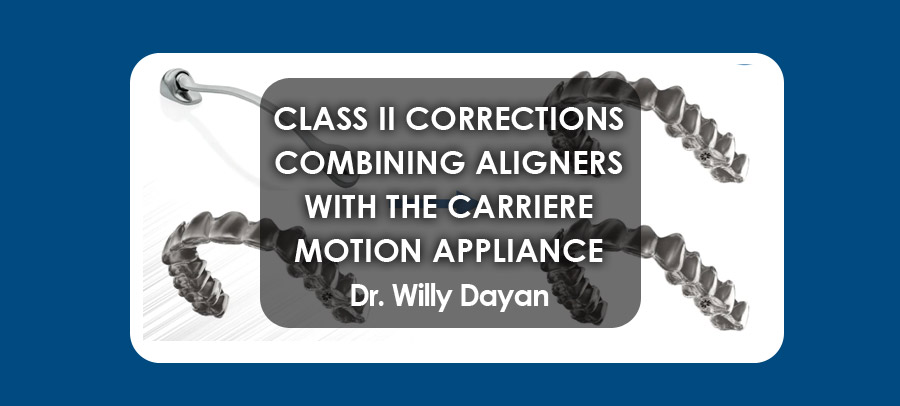 Class II Corrections By Combining Aligners with the Carriere Motion Appliance