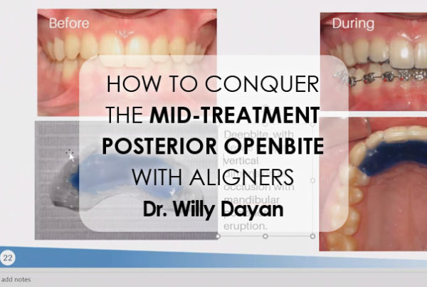 How To Conquer The Mid-Treatment Posterior Openbite With Aligners