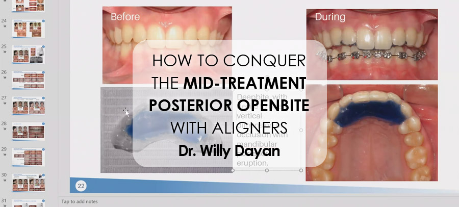 How To Conquer The Mid-Treatment Posterior Openbite With Aligners