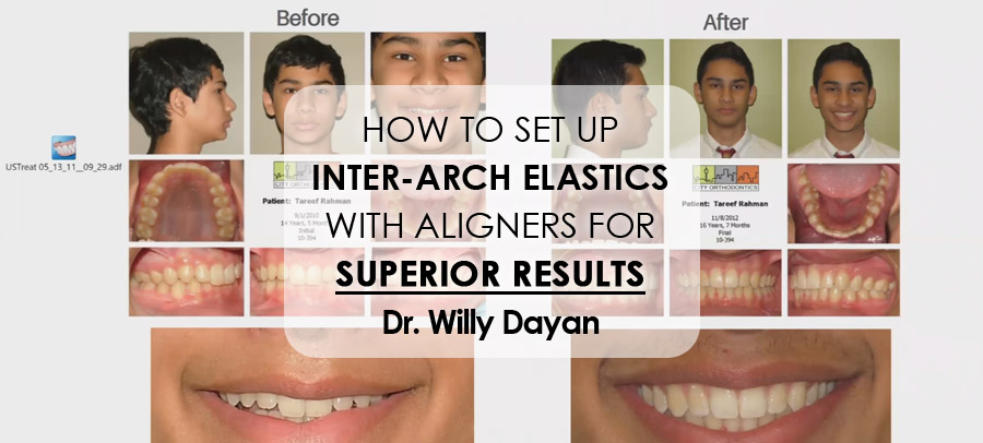 Settling the Braces Vs Aligners Debate (With More Questions) - Egger  Orthodontics