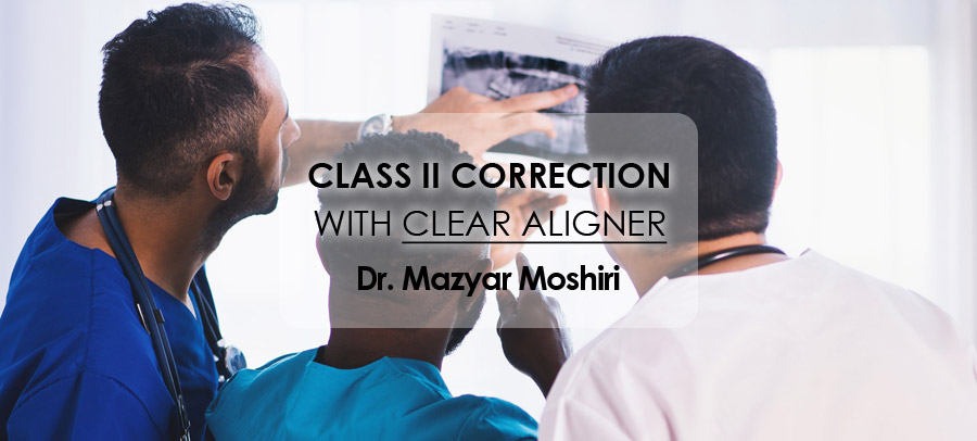 Webinar Class II Correction with Clear Aligner