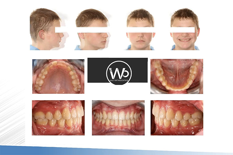 Combining Aligners with the Carrier Motion Appliance